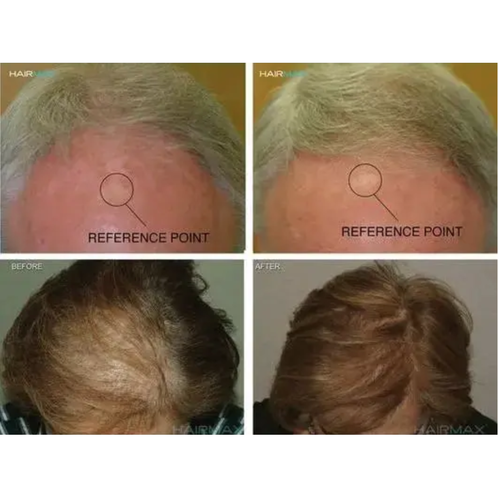 HairMax LaserCap 272 PowerFlex - lāzercepure (LASER 272)
