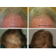HairMax LaserCap 272 PowerFlex - lāzercepure (LASER 272)