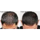 HairMax LaserBand 82 - ComfortFlex lāzerķemme-stīpa