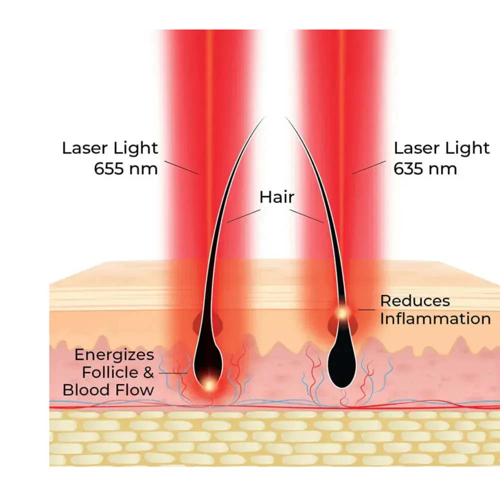 HairMax ACTONIS™ 18 DUAL ACTION LASERCOMB - Lāzerķemme